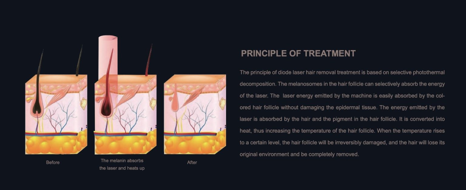 IPL T14-Ανάπλαση δέρματος